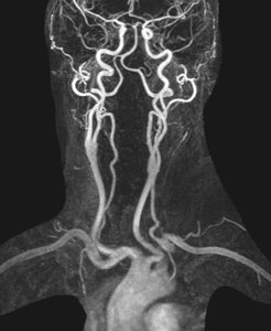 Beispiel für kontrastmittelunterstützte MR-Angiographie der hirnversorgenden Gefäße.