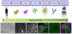 Fig. 4: Reprogramming human cells.Upper panel: Schematic drawing of the different steps of reprogramming, starting from human fibroblasts of patients affected by cortical malformations that are sequentially reprogrammed in neural stem cells and neurons (in vitro 2D) or in cerebral organoids (in vitro 3D).Lower panels: Examples of reprogrammed cells, IPSC, neural stem cells that are positive for phospho vimentin (PV) and Pax6, neurons positive for Tuj1.