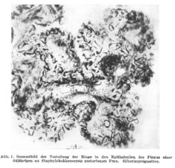 Distribution of Biondi ring tangles in epithelial cells of the choroid plexus (silver impregnation). From: Biondi, G. Zur Histopathologie des menschlichen Plexus chorioideus und des Ependyms. Archiv f. Psychiatrie 101, 666–728 (1934). https://doi.org/10.1007/BF01789997
