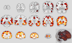 Neuroanatomische Muster der behaviouralen Variante der frontotemporalen Demenz (oben) und der Schizophrenie (unten)