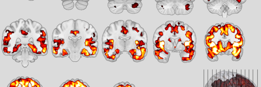 Neuroanatomical patterns of the behavioral variant of frontotemporal dementia 