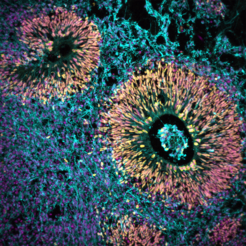 Human brain organoid, showing different cell types by colour: nuclei (magenta), progenitor cells (yellow), newborn neurons (blue).
