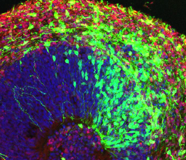 Cystatin B secretion in extracellular vesicles: new scenario underlying epilepsy in humans